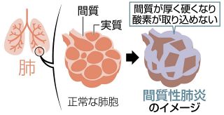 間質性肺炎　高齢化で増　息切れ、せき 見逃さずに　予後悪く 原因別で多様な種類