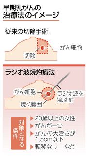 早期乳がんを切除せず治療　「ラジオ波焼灼療法」保険適用　乳房の変形や傷痕、最小限に