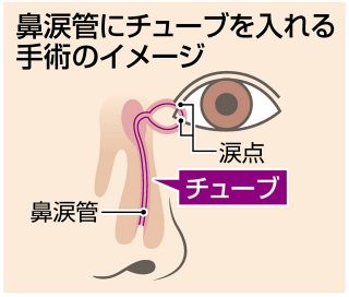 ＜ほくろとがん＞（上）放置…目頭近くに「基底細胞がん」　眼科と皮膚科で計3回手術