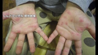 手足口病の感染者数　前週より減少も警報レベル続く　福岡県　