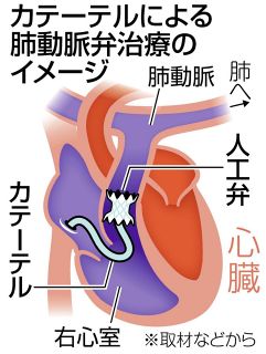 「肺動脈弁」治療　カテーテル導入　人工弁取り付け 体の負担軽く　開胸手術が必要な場合も